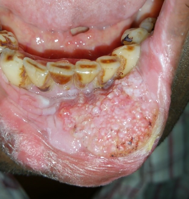 types of oral cancer - Cope with Cancer
